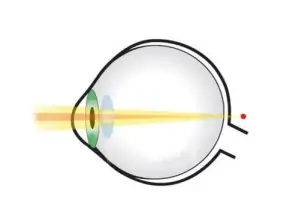 Sintomas de Astigmatismo Sintomas de Astigmatismo