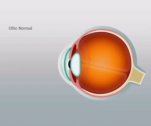 O que é o astigmatismo?